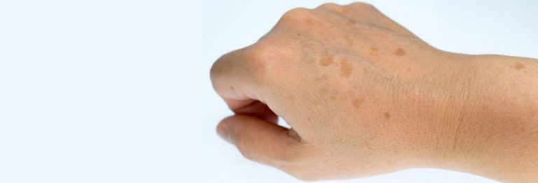 Tache Orange Sur Les Mains Au Réveil